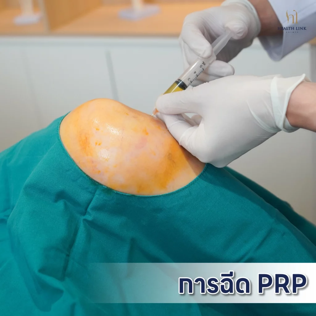 PRP Injection